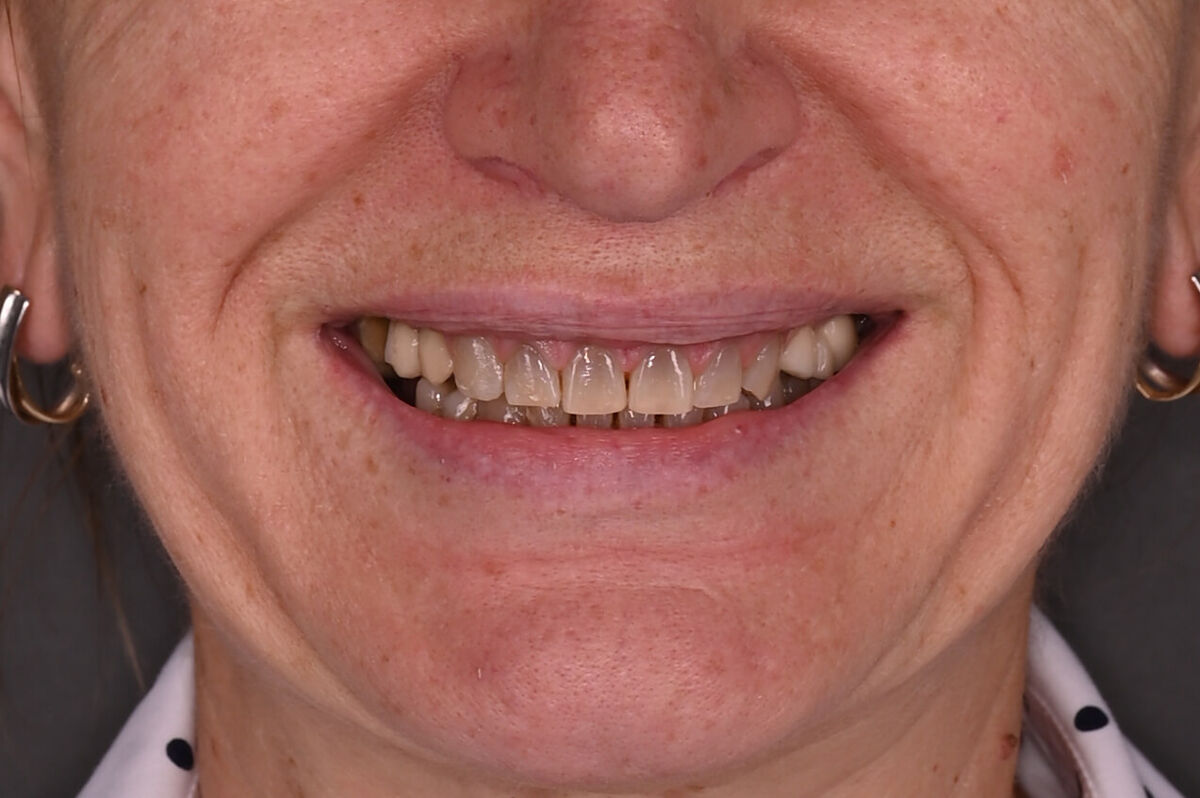 Zâmbet lateral stanga_înainte